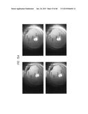 PROSTHETIC CAPSULAR DEVICES, SYSTEMS, AND METHODS diagram and image