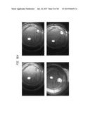 PROSTHETIC CAPSULAR DEVICES, SYSTEMS, AND METHODS diagram and image