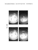 PROSTHETIC CAPSULAR DEVICES, SYSTEMS, AND METHODS diagram and image