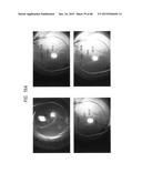 PROSTHETIC CAPSULAR DEVICES, SYSTEMS, AND METHODS diagram and image