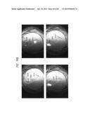 PROSTHETIC CAPSULAR DEVICES, SYSTEMS, AND METHODS diagram and image