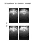 PROSTHETIC CAPSULAR DEVICES, SYSTEMS, AND METHODS diagram and image