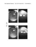 PROSTHETIC CAPSULAR DEVICES, SYSTEMS, AND METHODS diagram and image