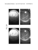 PROSTHETIC CAPSULAR DEVICES, SYSTEMS, AND METHODS diagram and image