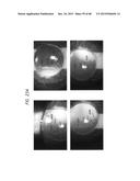 PROSTHETIC CAPSULAR DEVICES, SYSTEMS, AND METHODS diagram and image