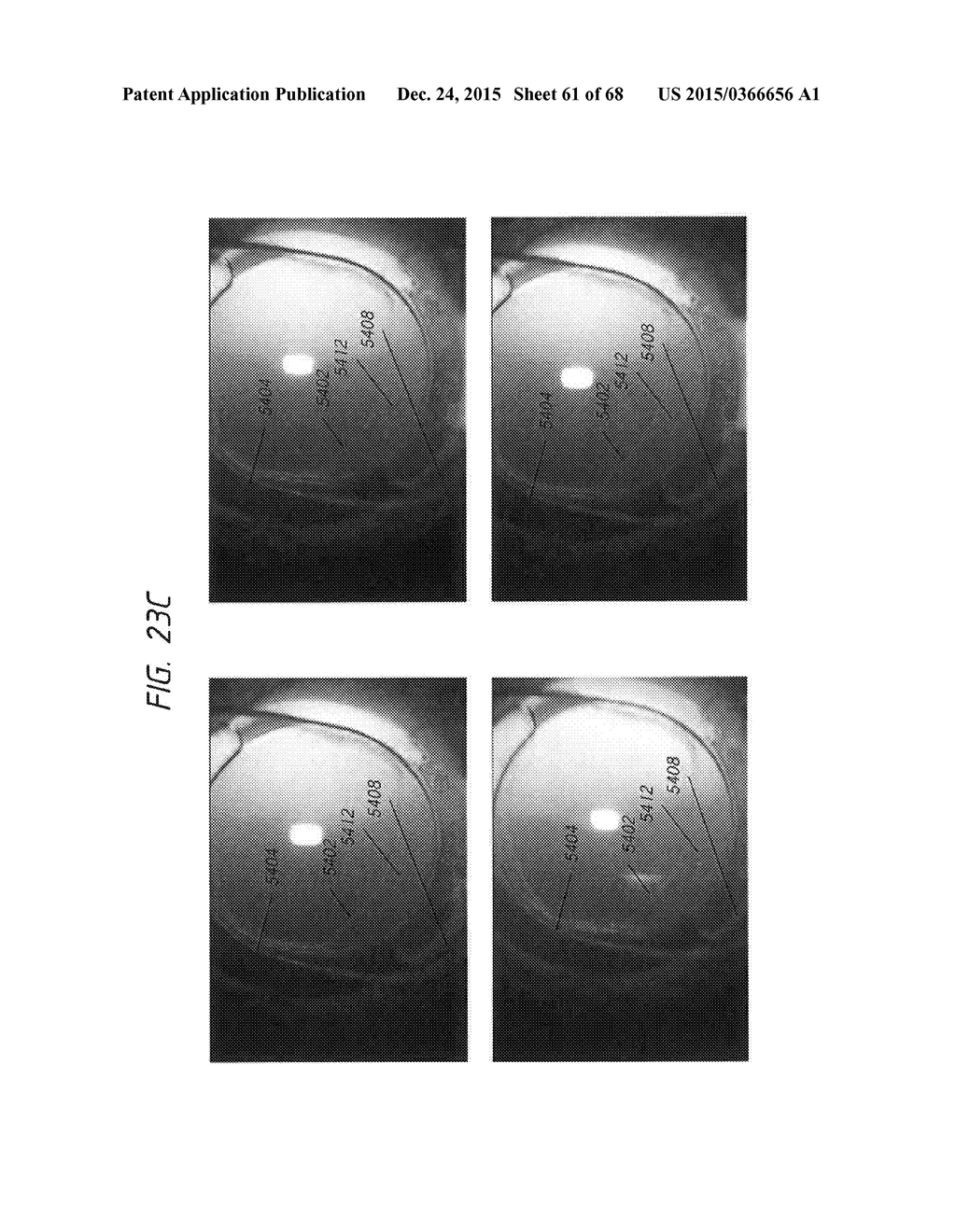 PROSTHETIC CAPSULAR DEVICES, SYSTEMS, AND METHODS - diagram, schematic, and image 62