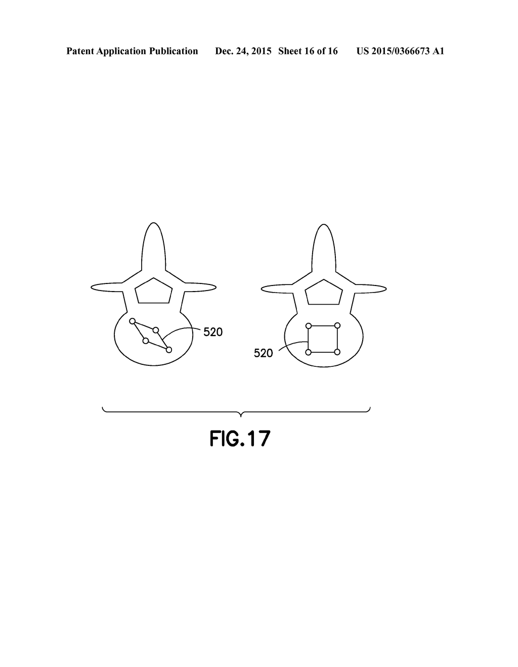 PLASTICALLY DEFORMABLE INTER-OSSEOUS DEVICE - diagram, schematic, and image 17