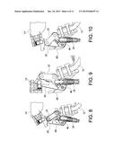 PROSTHETIC KNEE diagram and image