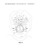 BREATHING MASK ARRANGEMENT AS WELL AS AN APPLICATION DEVICE AND A FOREHEAD     SUPPORT DEVICE FOR SAME diagram and image