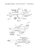 STRETCH VALVE BALLOON CATHETER AND METHODS FOR PRODUCING AND USING SAME diagram and image