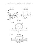 SYSTEMS AND METHODS FOR SHUNTING FLUID diagram and image