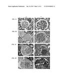 ANTI-HISTONE THERAPY FOR VASCULAR NECROSIS IN SEVERE GLOMERULONEPHRITIS diagram and image