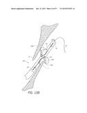 Suturing Devices and Methods for Closing a Patent Foramen Ovale diagram and image