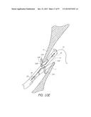 Suturing Devices and Methods for Closing a Patent Foramen Ovale diagram and image