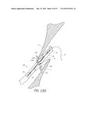 Suturing Devices and Methods for Closing a Patent Foramen Ovale diagram and image