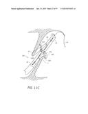 Suturing Devices and Methods for Closing a Patent Foramen Ovale diagram and image