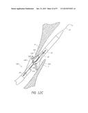 Suturing Devices and Methods for Closing a Patent Foramen Ovale diagram and image