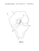 METHODS OF MAKING REINFORCED SOFT TISSUE GRAFTS WITH SUTURE LOOP/NEEDLE     CONSTRUCTS diagram and image