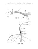 METHODS OF MAKING REINFORCED SOFT TISSUE GRAFTS WITH SUTURE LOOP/NEEDLE     CONSTRUCTS diagram and image