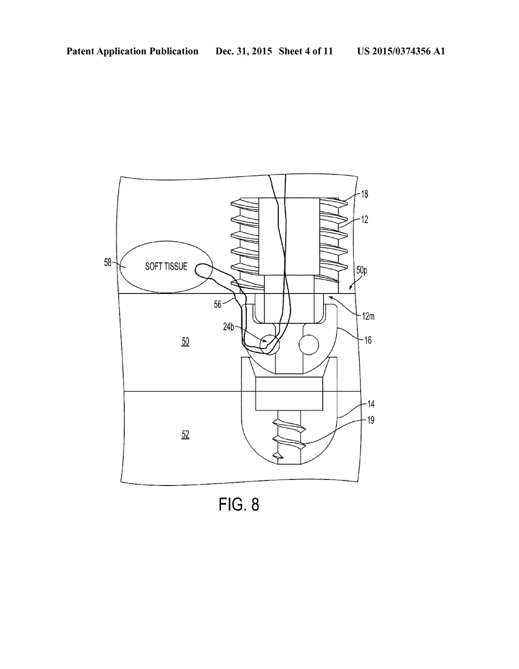 Knotless Suture Anchor - diagram, schematic, and image 05