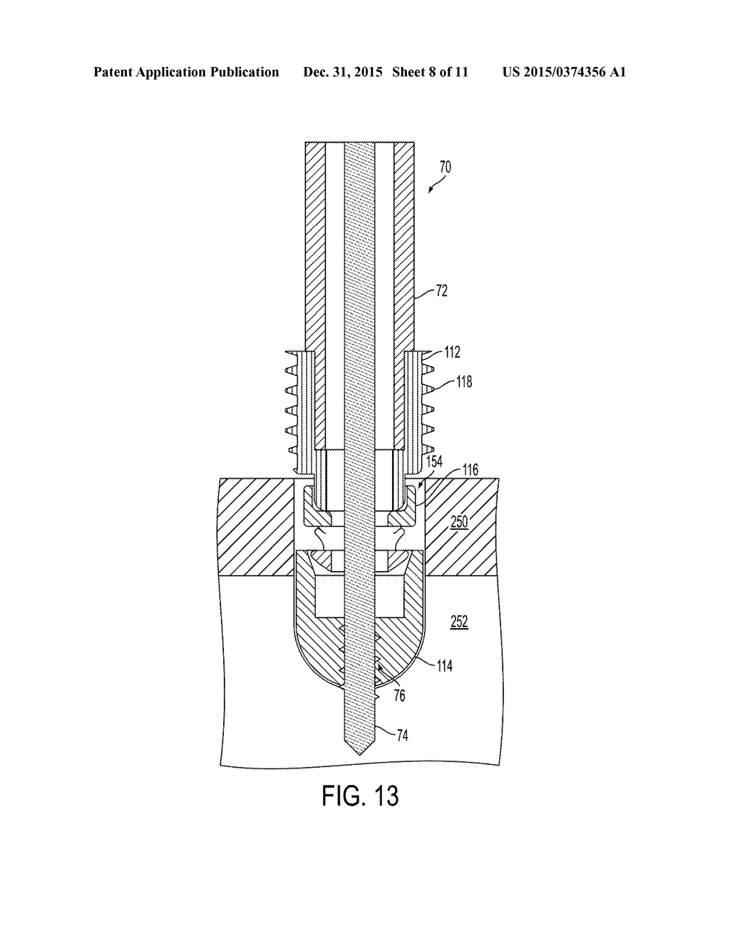 Knotless Suture Anchor - diagram, schematic, and image 09