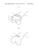 MODULARIZED PATIENT-SPECIFIC REGISTRATION GUIDE AND SYSTEM USING SAME diagram and image