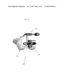 ANATOMICALLY GUIDED INSTRUMENTATION FOR TROCHLEAR GROOVE REPLACEMENT diagram and image