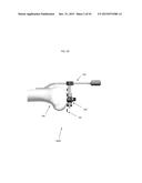 ANATOMICALLY GUIDED INSTRUMENTATION FOR TROCHLEAR GROOVE REPLACEMENT diagram and image