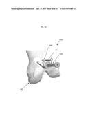 ANATOMICALLY GUIDED INSTRUMENTATION FOR TROCHLEAR GROOVE REPLACEMENT diagram and image