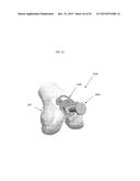 ANATOMICALLY GUIDED INSTRUMENTATION FOR TROCHLEAR GROOVE REPLACEMENT diagram and image