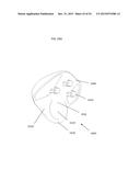 ANATOMICALLY GUIDED INSTRUMENTATION FOR TROCHLEAR GROOVE REPLACEMENT diagram and image