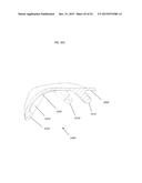 ANATOMICALLY GUIDED INSTRUMENTATION FOR TROCHLEAR GROOVE REPLACEMENT diagram and image