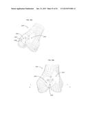 ANATOMICALLY GUIDED INSTRUMENTATION FOR TROCHLEAR GROOVE REPLACEMENT diagram and image