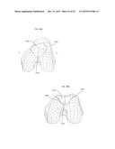 ANATOMICALLY GUIDED INSTRUMENTATION FOR TROCHLEAR GROOVE REPLACEMENT diagram and image