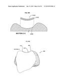 ANATOMICALLY GUIDED INSTRUMENTATION FOR TROCHLEAR GROOVE REPLACEMENT diagram and image