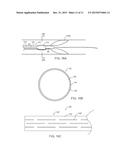 APPARATUS AND METHODS FOR ACCESSING AND REMOVING MATERIAL FROM BODY LUMENS diagram and image