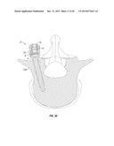 ORTHOPEDIC FIXATION DEVICES AND METHODS OF INSTALLATION THEREOF diagram and image