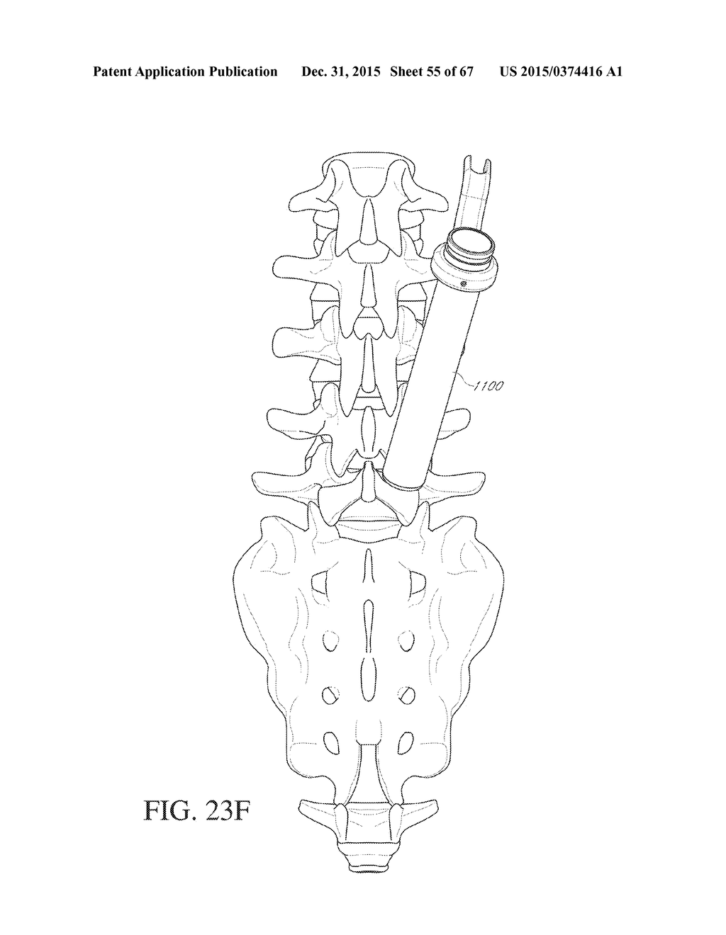 METHOD AND APPARATUS FOR SPONDYLOLYSIS REPAIR - diagram, schematic, and image 56