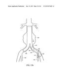 BRANCHED VESSEL ENDOLUMINAL DEVICE diagram and image