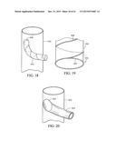 BRANCHED VESSEL ENDOLUMINAL DEVICE diagram and image