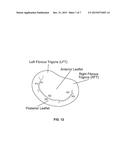 HEART VALVE REPAIR DEVICES FOR PLACEMENT IN VENTRICLE AND DELIVERY SYSTEMS     FOR IMPLANTING HEART VALVE REPAIR DEVICES diagram and image