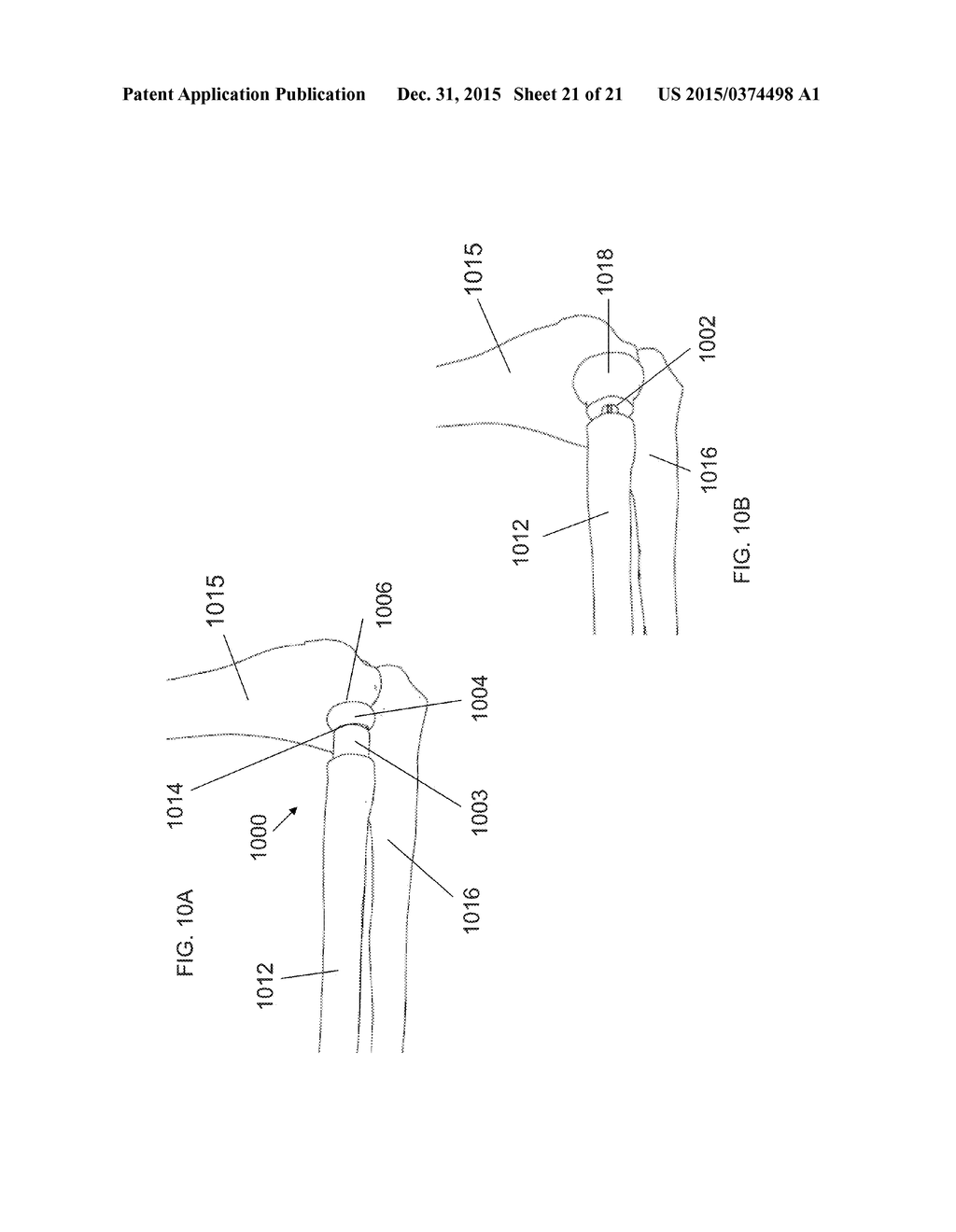 Photodynamic Articular Joint Implants and Methods of Use - diagram, schematic, and image 22