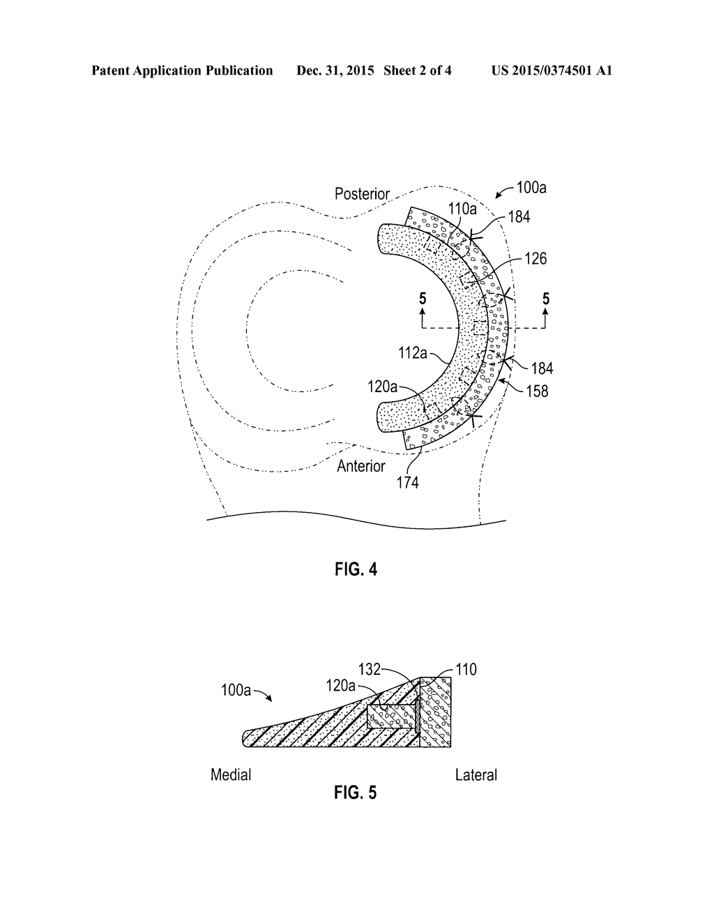 METHOD AND IMPLANT FOR REPLACING DAMAGED MENISCAL TISSUE - diagram, schematic, and image 03