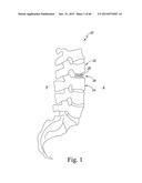 EXPANDABLE SPINAL INTERBODY AND INTRAVERTEBRAL BODY DEVICES diagram and image