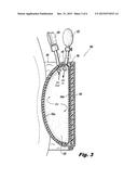 UTERINE COMPRESSION DEVICES AND METHODS diagram and image