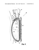 UTERINE COMPRESSION DEVICES AND METHODS diagram and image