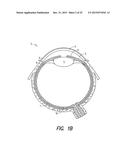 LACRIMAL IMPLANT DETECTION diagram and image