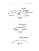 SYSTEM AND METHOD FOR LASER CORNEAL INCISIONS FOR KERATOPLASTY PROCEDURES diagram and image