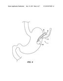 BARIATRIC DEVICE AND METHOD diagram and image