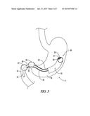 BARIATRIC DEVICE AND METHOD diagram and image